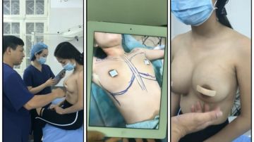 从咸鱼淘来的整容医院偷拍视频做完隆胸手术的妹子来医院复查前后对比这医生的手艺还真不错